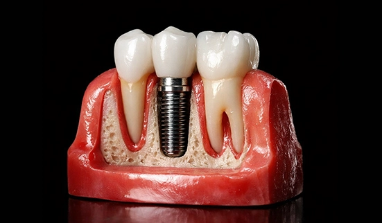 Implante Unitário — Sermais Odonto