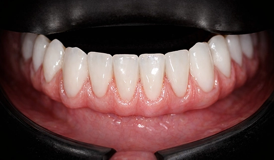 Prótese Fixa — Sermais Odonto