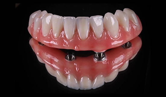 Prótese Protocolo — Sermais Odonto